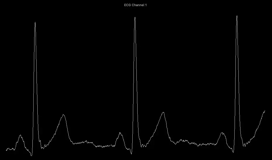 An ECG trace recorded by the device, showing three consecutive heartbeats